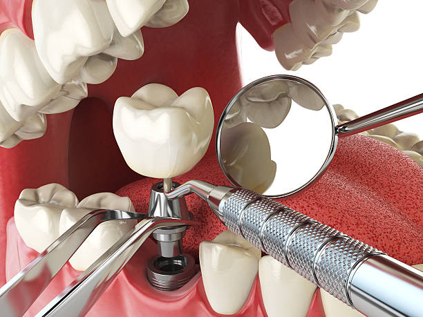 Best Emergency Dental Extractions in Norton Center, MA